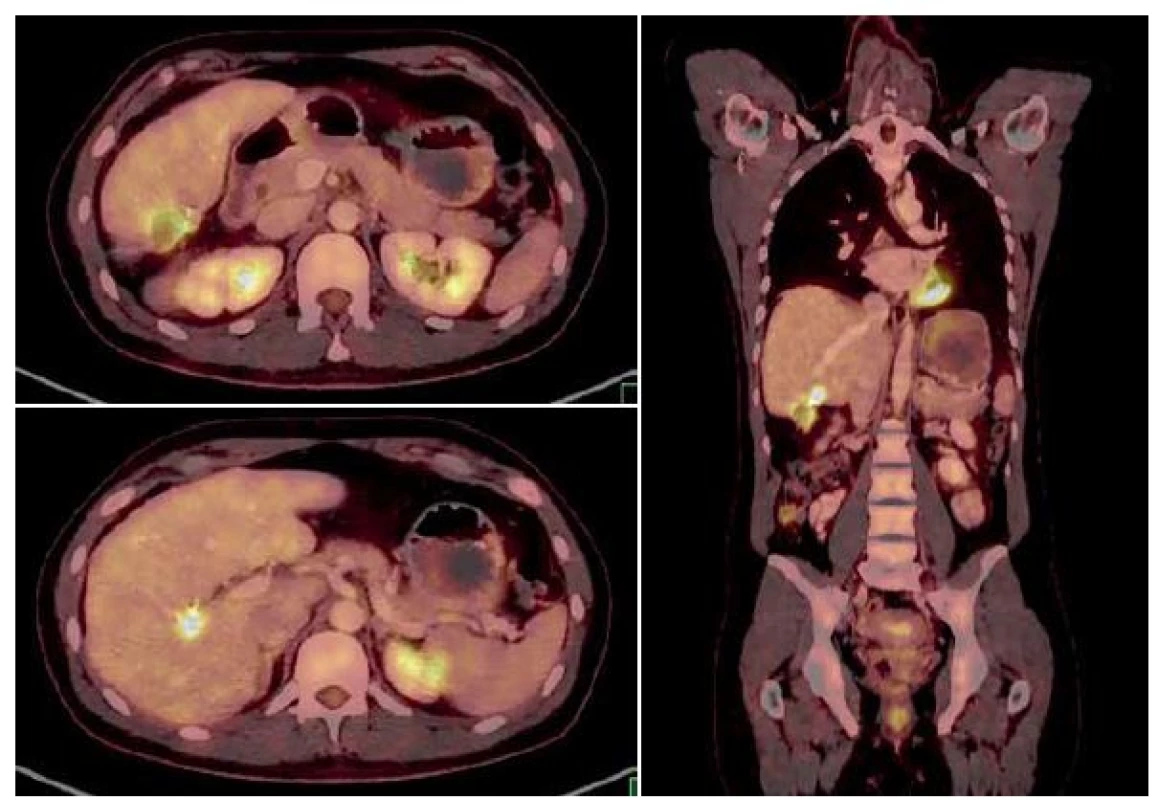 PET/CT scans prior to the second surgical intervention – recurrence
