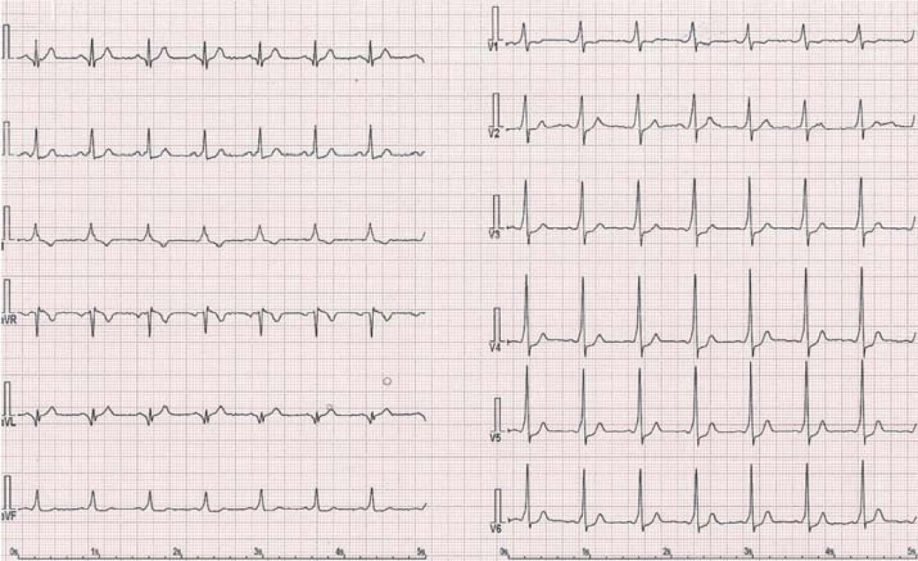 Obraz preexcitace u pacienta s WPW syndromem – akcesorní dráha vlevo anterolaterálně.