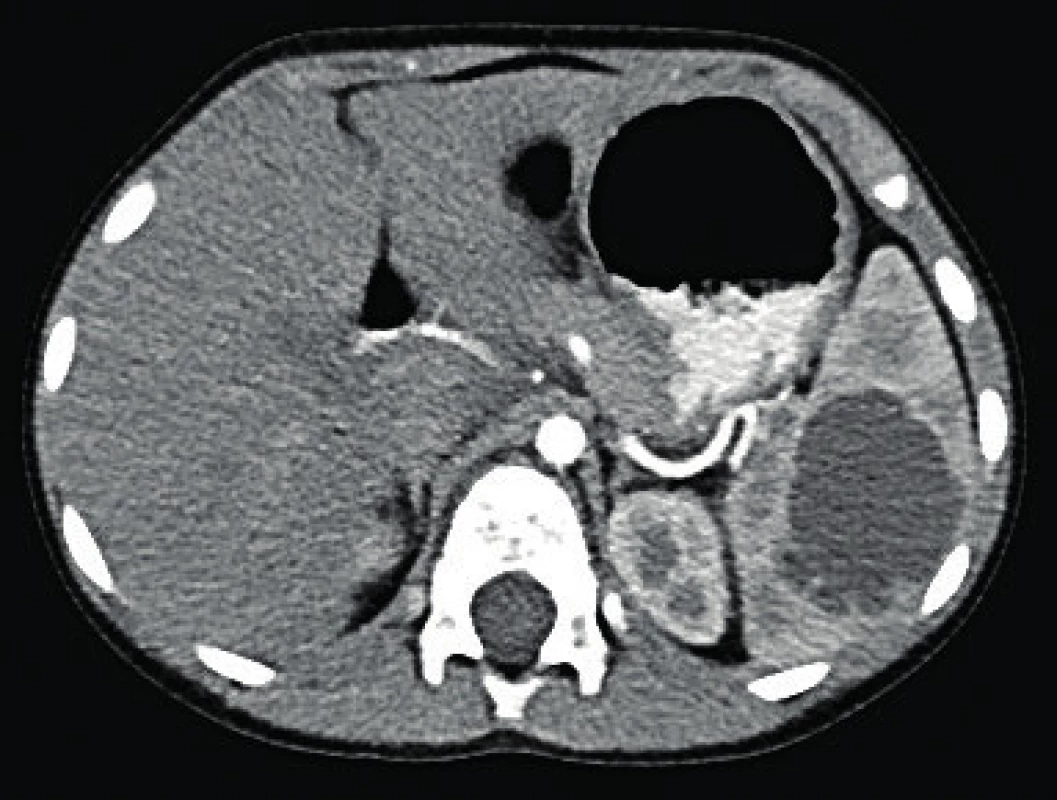 CT obraz sleziny s centrálne uloženou cystou.<br>
Fig. 1. CT scan of the spleen with the cyst centrally located.