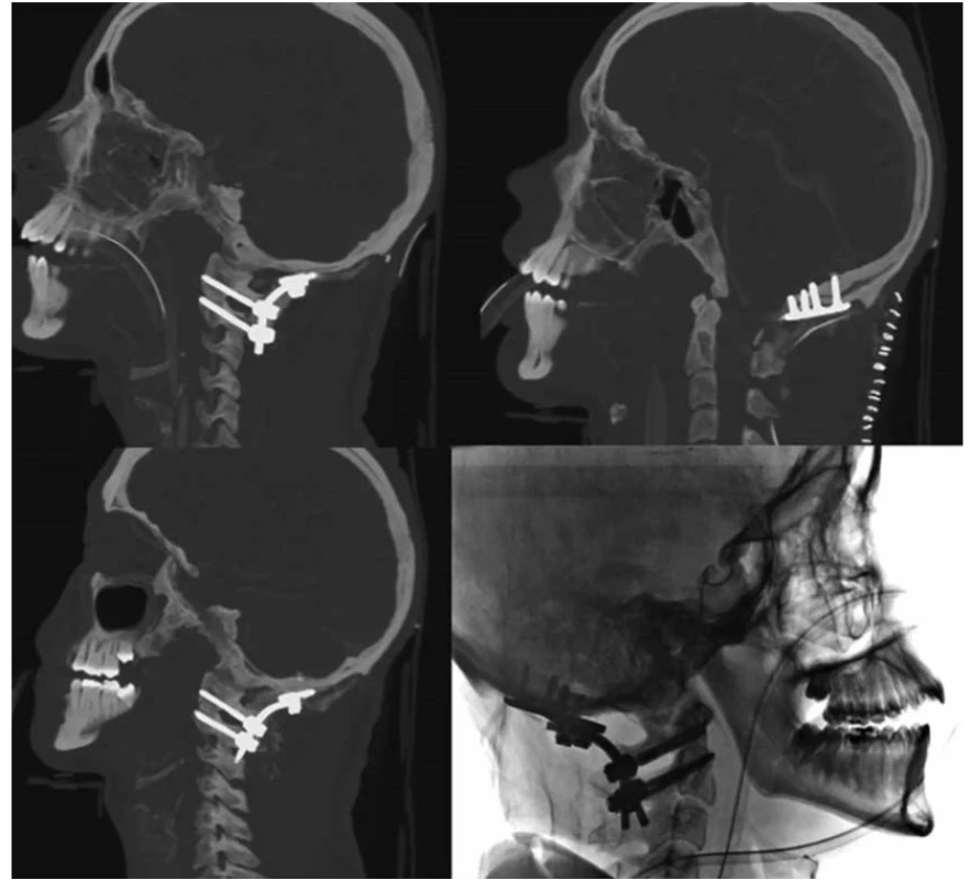 Úspěšná akutní zadní kraniocervikální fixace a fúze C0-C2 s optimální repozicí AOD<br>
Fig. 5. Successful acute posterior C0-C2 craniocervical fixation and fusion, with optimal AOD reposition