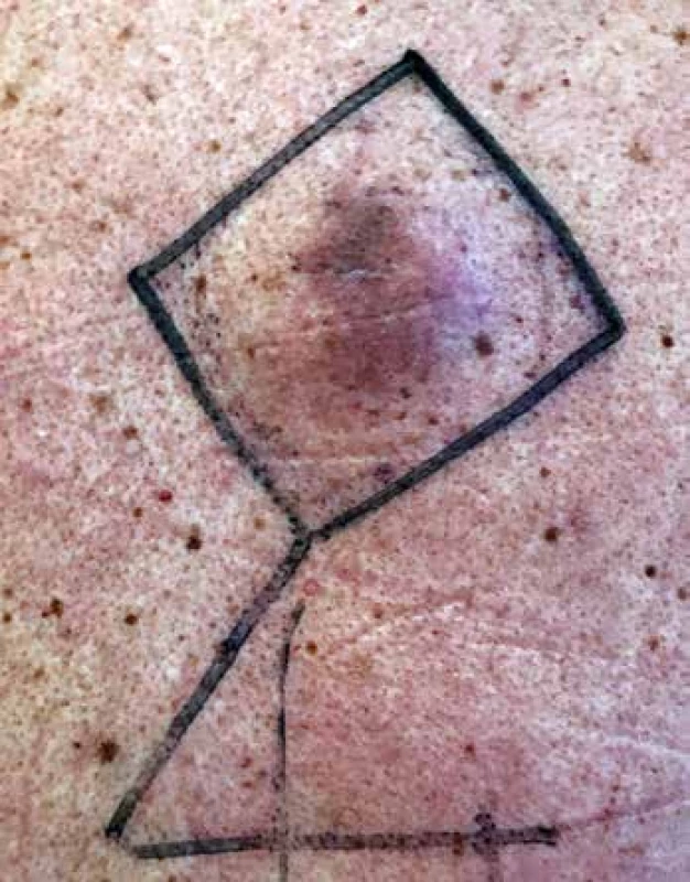 Makroskopická fotografie lokálního nálezu před radikální excizí – fialovo-hnědý palpačně tuhý podkožní útvar na zádech. Kresba fixou zobrazuje plánovanou linii chirurgického řezu s plánovanou plastikou Limbergovým lalokem.
