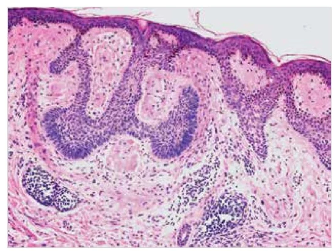 Sekundární kožní amyloidóza – histopatologie<br>
Eozinofilní depozita ve stromatu bazaliomu. Barvení HE, původní
zvětšení 100krát.