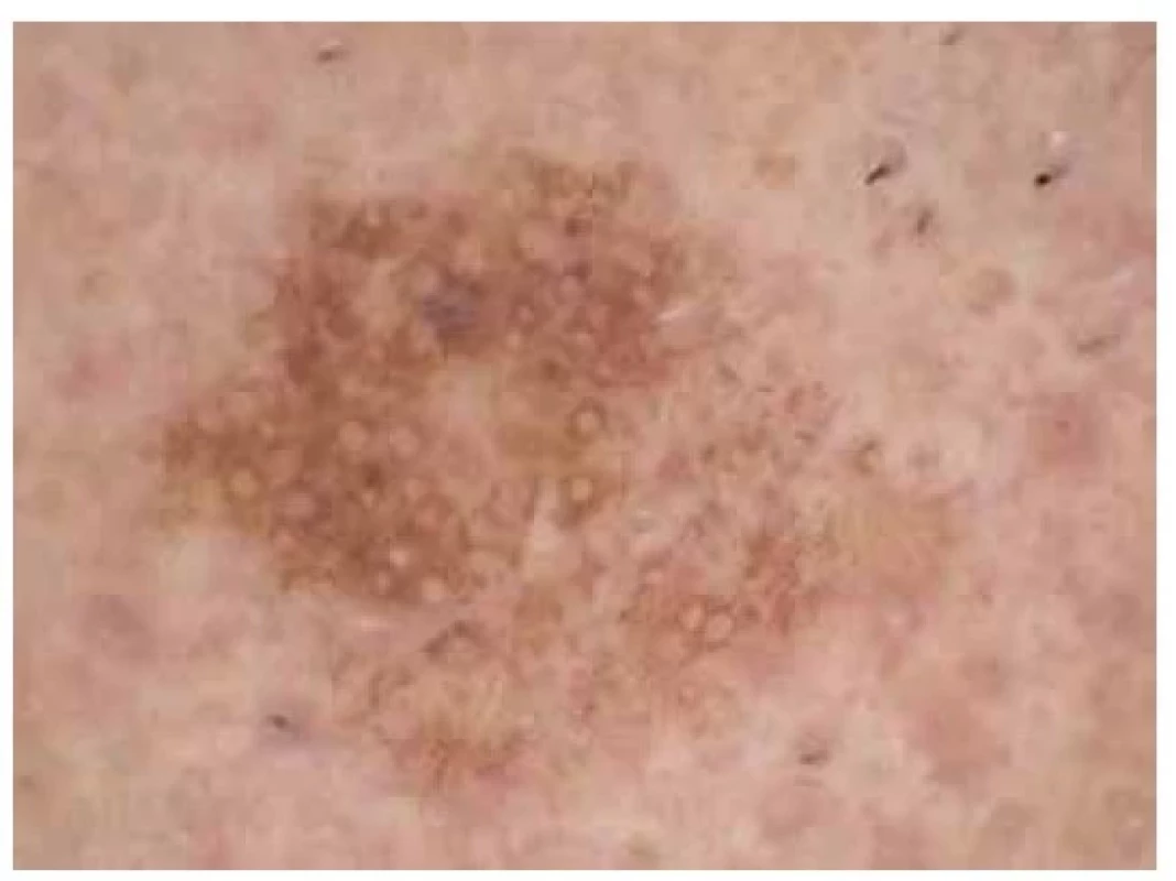 Seboroická veruka*<br>
Dermatoskopicky světle hnědé paralelně probíhající linie
(fenomén otisku prstu), nápadně ostré ohraničení, někde
rozšířené vlasové folikuly.