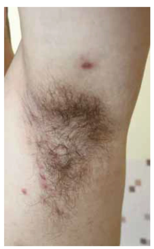 Hidradenitis suppurativa,
mierna závažnosť ochorenia Hurley I
v oblasti ľavej axily s prítomným zápalovým
nodulom.<br>
Fig. 1. Patient with mild stage hidradenitis
suppurativa (Hurley I) in left
axillary region with accompanying inflammatory nodule.