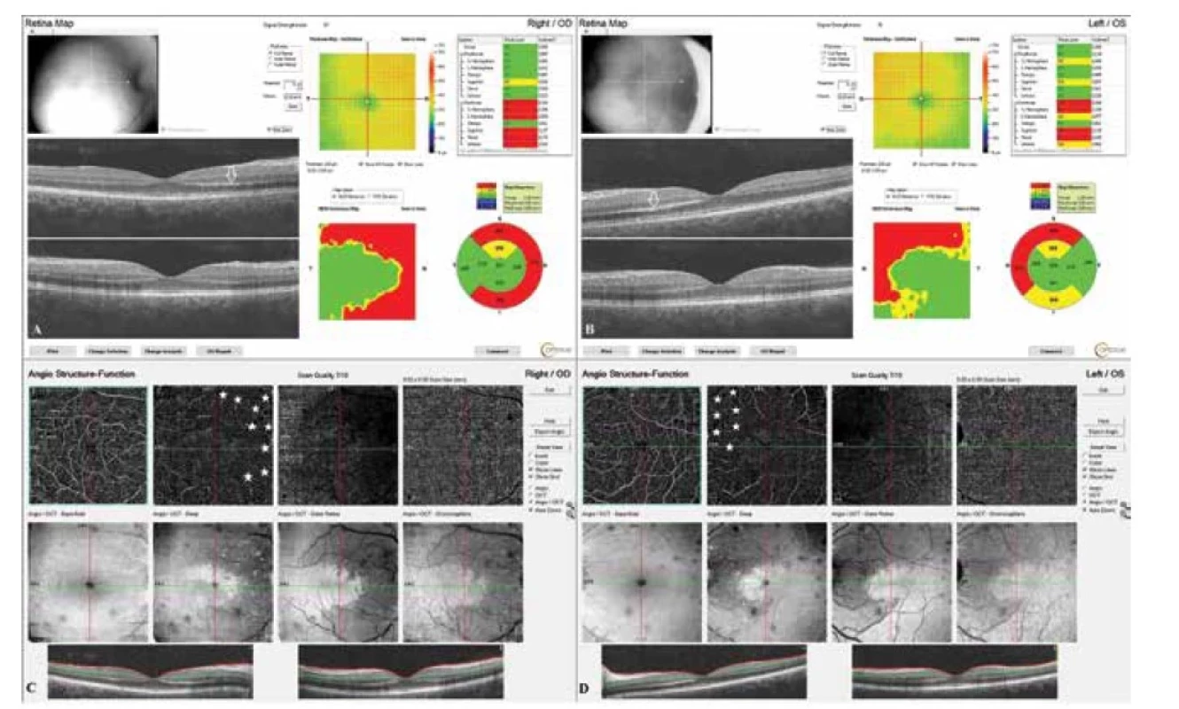 Vstupné OCT vyšetrenie makuly s hyperreflexným pásom vo vonkajšej jadrovej vrstve (biele šípky) a edémom neuroretiny
nazálne (A, B). OCTA so zobrazením ischémie sietnice povrchového a hlbokého (biele hviezdičky) kapilárneho plexu
(C, D)