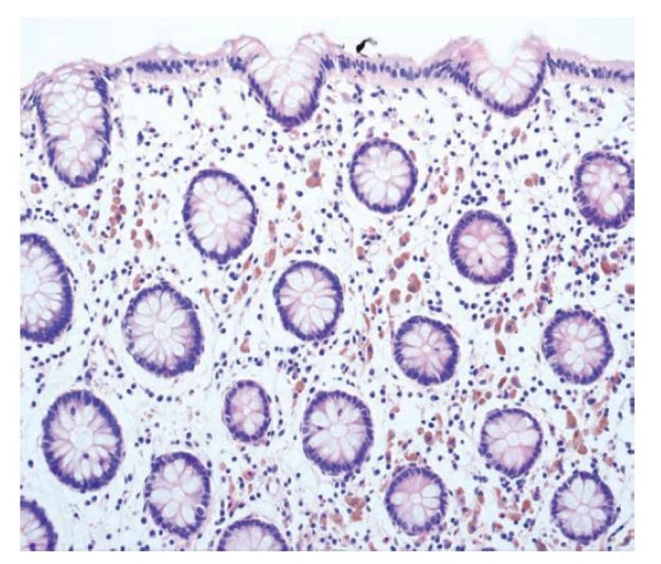 Melanosis coli. Melanosis coli s přítomností početných pigmentovaných
makrofágů v lamina propria (hematoxylin a eosin; 200x).