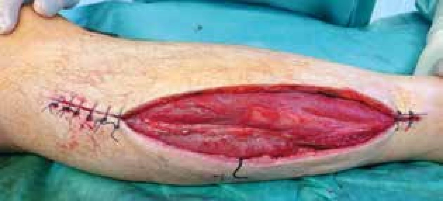 Fasciotomie, resutura okrajů <br>Fig. 1: Fasciotomy; suture to approximate the woundedges
