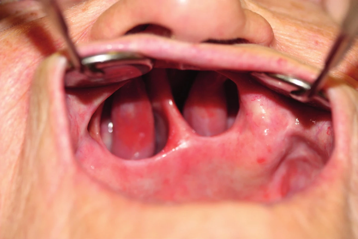 Example of Ib. class defect after spinocellular carcinoma extirpation – 8 years after surgery (author’s archive)