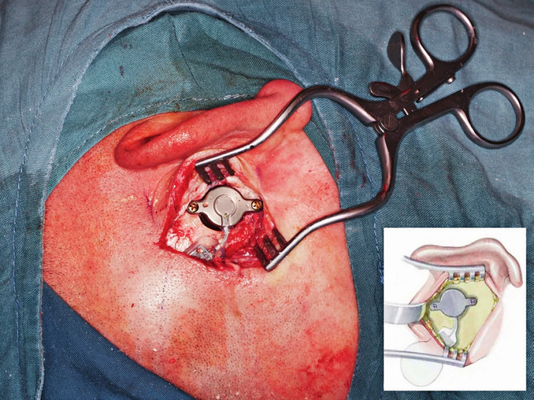 Operace: transmastoidní přístup - finální fáze - cívka
implantabilní části zavedena do podkožní kapsy, transducer uložen
do připraveného kostního lůžka a ukotven dvěma kortikálními
šrouby.