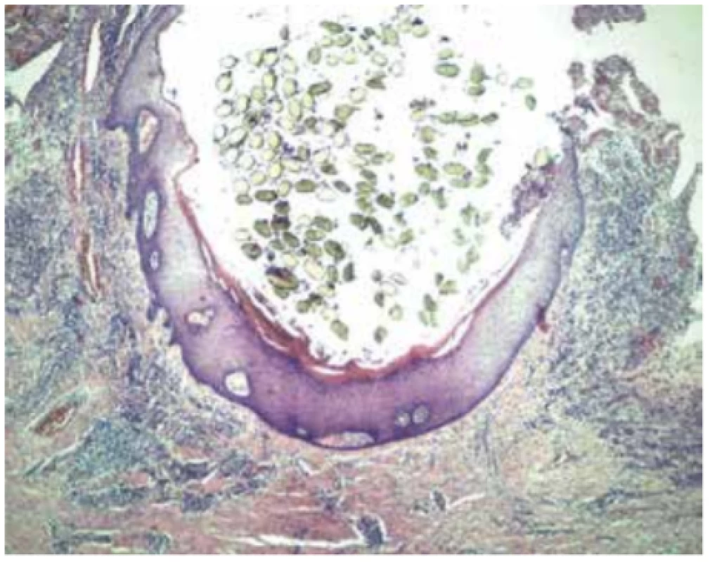 Histologický obraz pilonidálního sinu (archiv autorů)<br>
Fig. 3: Histologicalviewofpilonidal sinus (authors´ archive)