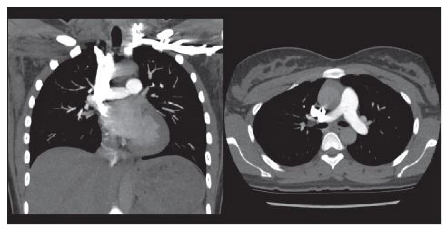 Subsegmentární emboly velikosti několika mm. Větve plicní tepny vyššího řádu. Case courtesy of Dr Andrew Dixon, Radiopaedia.org, rID: 36509.