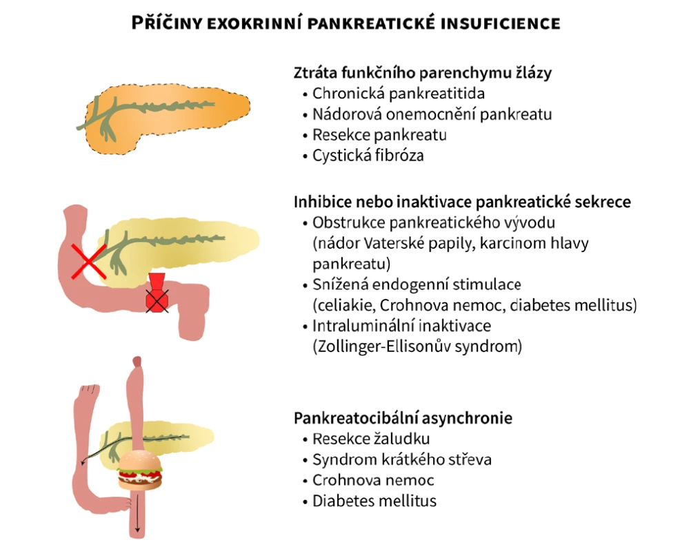 Schéma jednotlivých příčin exokrinní pankreatické insuficience. Upraveno dle Keller et al. (28), vytvořeno ve spolupráci se Servisním střediskem
pro e-learning, Fakulta informatiky Masarykovy univerzity