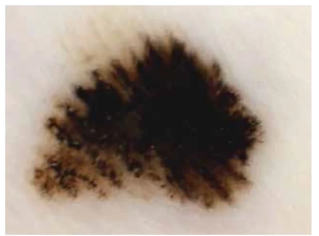 Melanoma in situ<br>
„Parallel ridge pattern” – paralelně probíhající široká lineární
pigmentace nad cristae superficiales, nevidíme
akrosyringia.