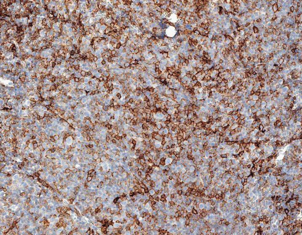 Histologie z biopsie mízní uzliny, zvětšení 200×, pozitivita CLL pozadí i velkobuněčné komponenty při imunohistochemickém barvení CD20