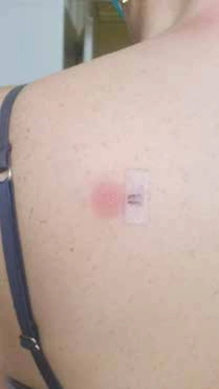 Pozitívny epikutánny test so Zinnatom<br>
30-% koncentrácia originálneho lieku Zinnat 250 mg tbl v bielej
vazelíne, odčítavanie po 72 hodinách