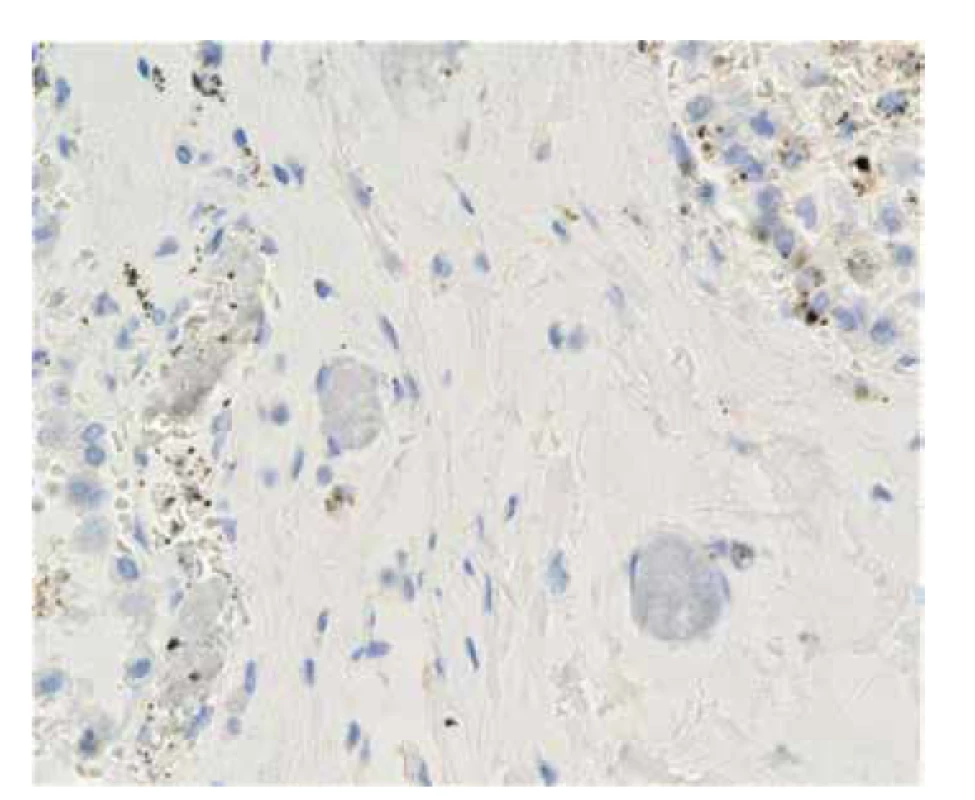 Případ č. 2. Negativní imunohistochemicky průkaz CD61 v embolizovaném
polymeru (zvětšeno 400x).