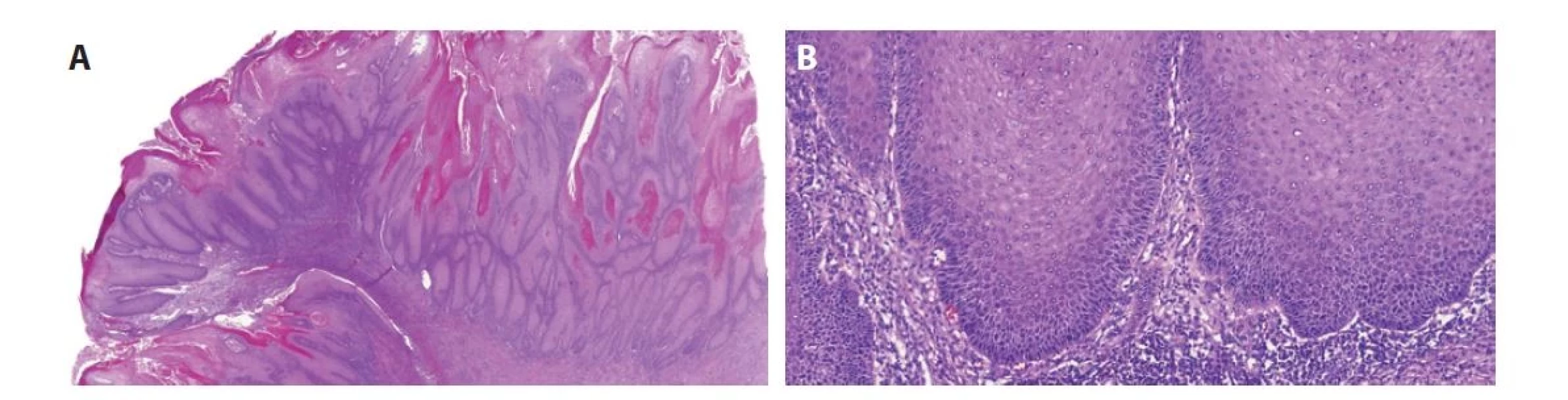 Verukózní karcinom je papilárně rostoucí dobře diferencovaný tumor neinfiltrující do stromatu (vyznačuje se tzv. „pushing pattern of infiltration“)
(A). Tumor nevykazuje výraznější cytologické atypie (B).