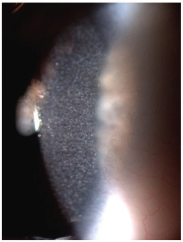 Krystalky cystinu v rohovce
u 2,5letého chlapce
s infantilní cystinózou
a projevy fotofobie.<br>
Fig. 5. Cystine crystals in cornea
of 2.5-year-old boy with
infantile cystinosis and
photophobia.