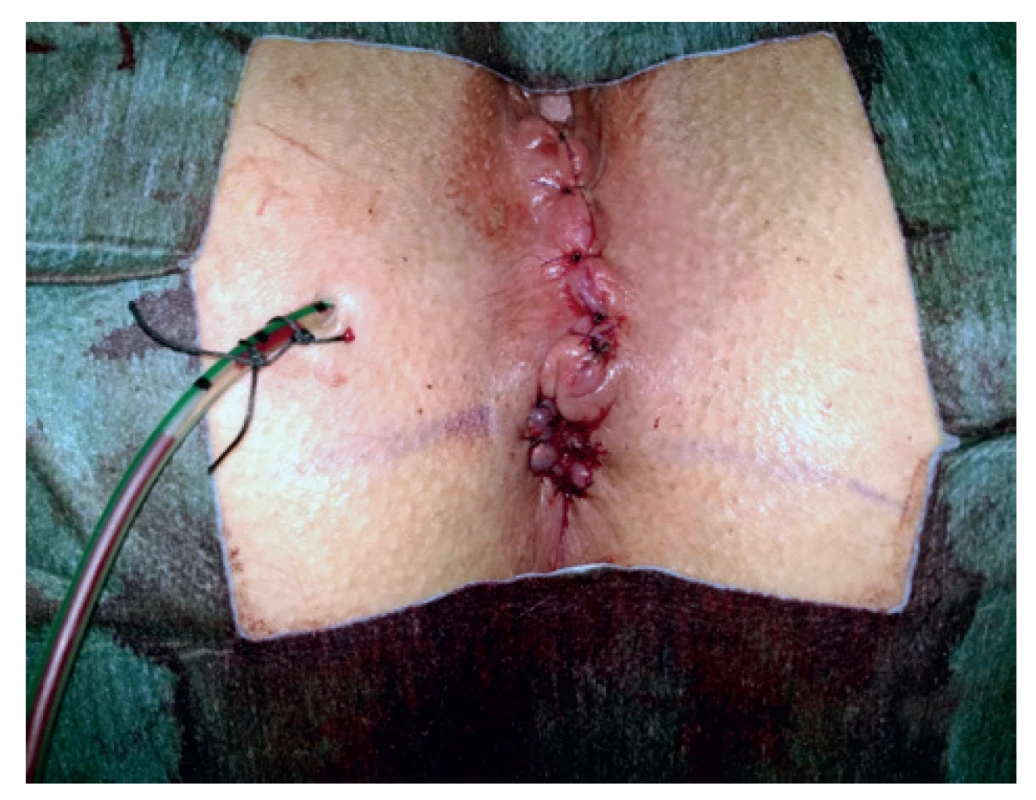 Anokutální anastomóza se zašitým defektem po píštěli<br>
Fig. 5: Anocutaneous anastomosis with the defect from fistula
removal sutured