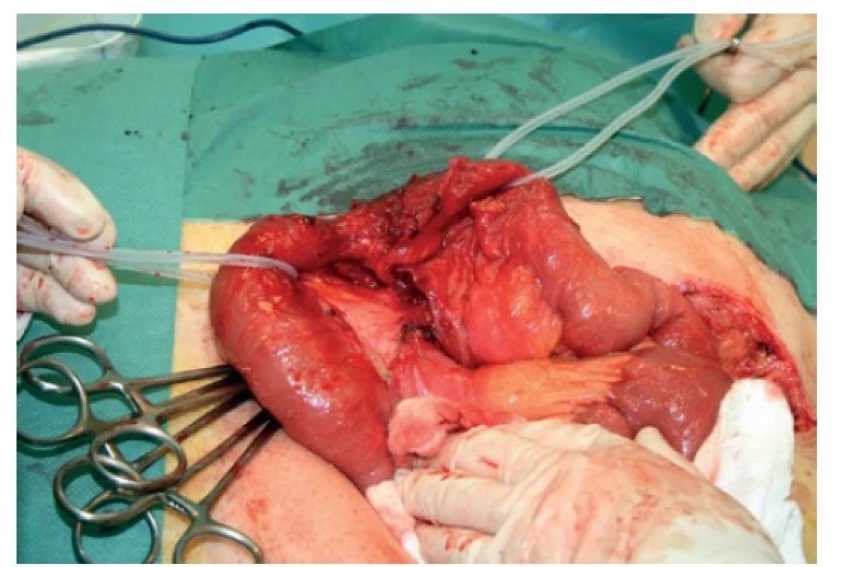 Strangulační ileus tenké kličky 5 let po resekci rekta
pro karcinom<br>
Fig. 1: Strangulated small bowel obstruction 5 years after
rectal carcinoma resection
