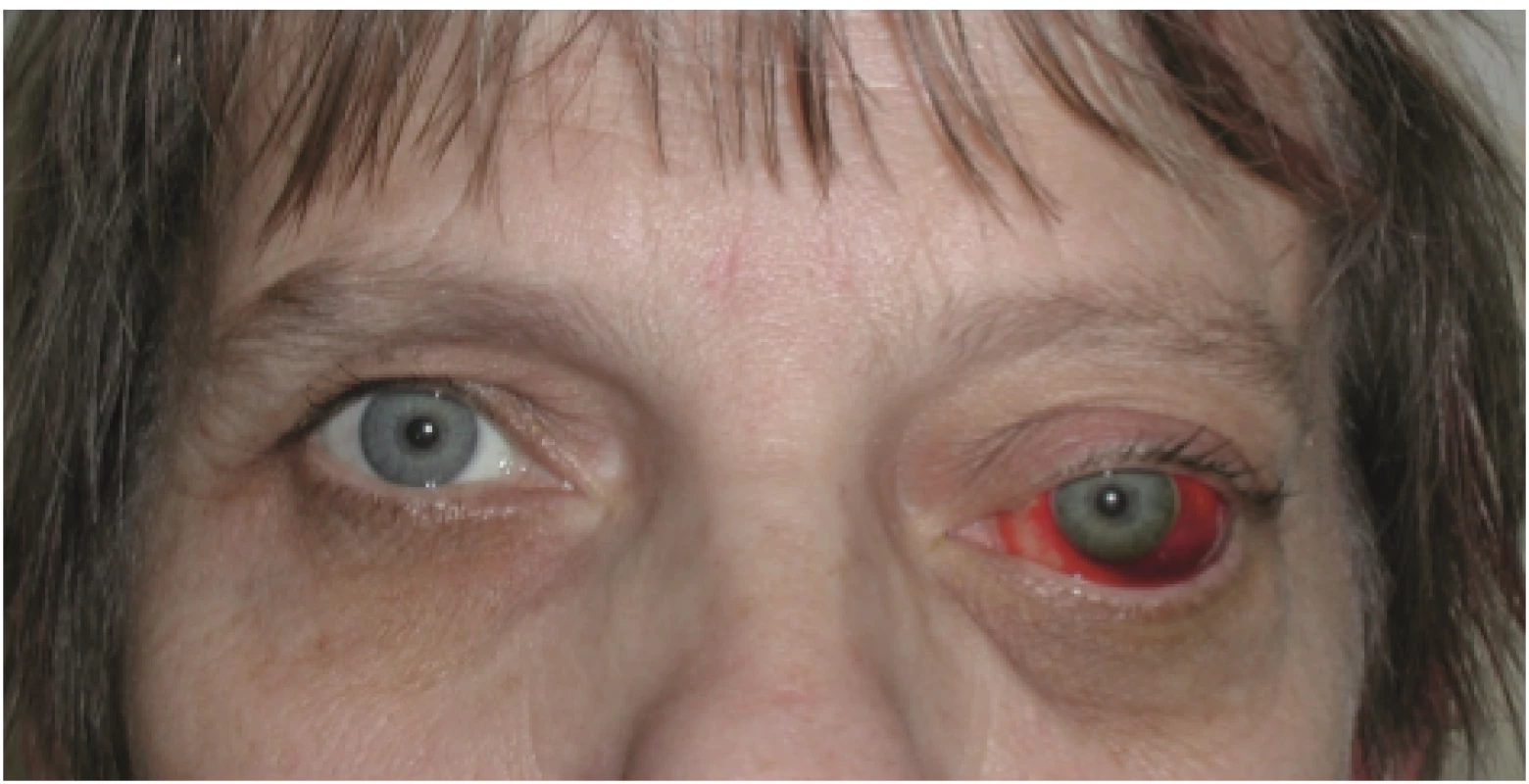 Paraaxial exophthalmos with downward shift of eyeball in lymphangioma in the upper intraconal space in the left eye. Subconjunctival suffusion following spontaneous haemorrhage