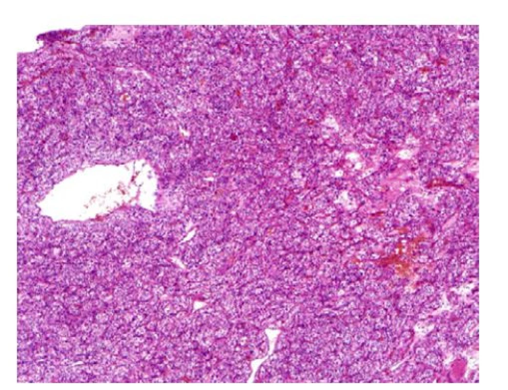 Histologický preparát pravé ledviny, kde světlobuněčný
karcinom v základním barvení Hematoxillin
Eozin, zvětšení 100x; zdroj: Šiklův patologický
ústav FN Plzeň<br>
Fig. 5. Histological specimen of the right kidney
showing clear cell carcinoma in basic staining with
hematoxylin-eosin; a magnification of 100x; source:
Šikl Institute of Pathology, Pilsen University Hospital