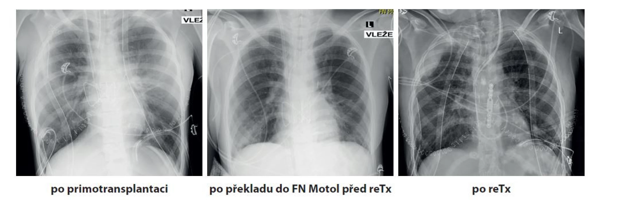 RTG snímky hrudníku, předozadní, odshora dolů: po primotransplantaci, po překladu do FN Motol před retransplantací,
po retransplantaci. Na prvním a posledním snímku lze vidět zavedené hrudní drény.<br>
Fig. 1: Chest X-rays, anteroposterior view, from top to bottom: after 1st lung transplantation, after patient admission to
University Hospital Motol before retransplantation, after retransplantation. Chest drains can be seen un the first and
last scans.