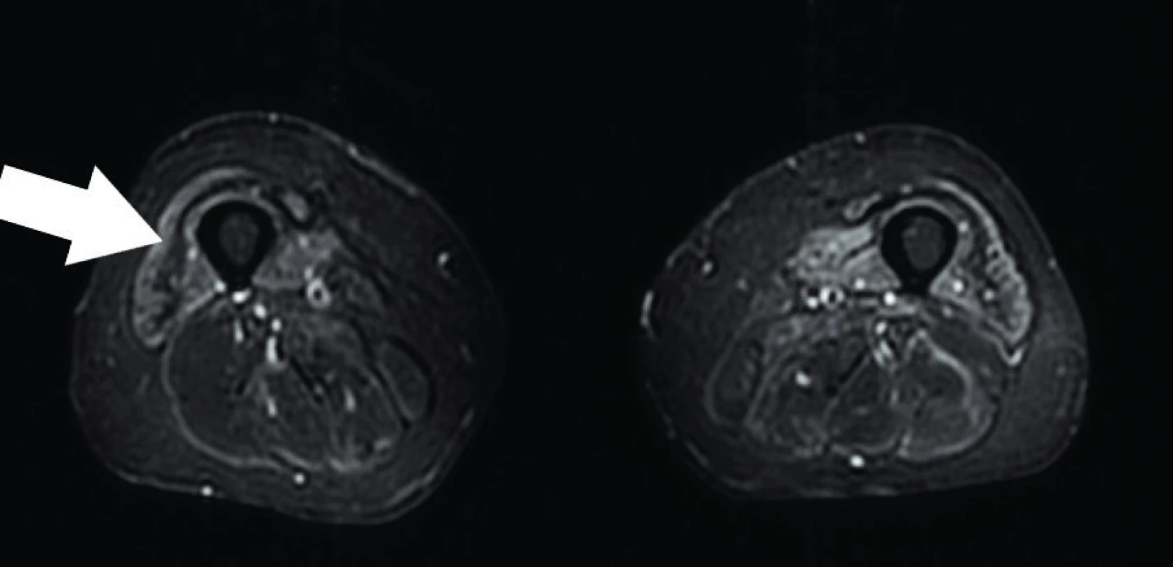 Axiální STIR sekvence – undulating fascia sign u pacienta se sporadickou myozitidou s inkluzními tělísky. Zdroj: Archiv Revmatologického ústavu (ÚVN Střešovice, Discovery 450; 1,5 T)

