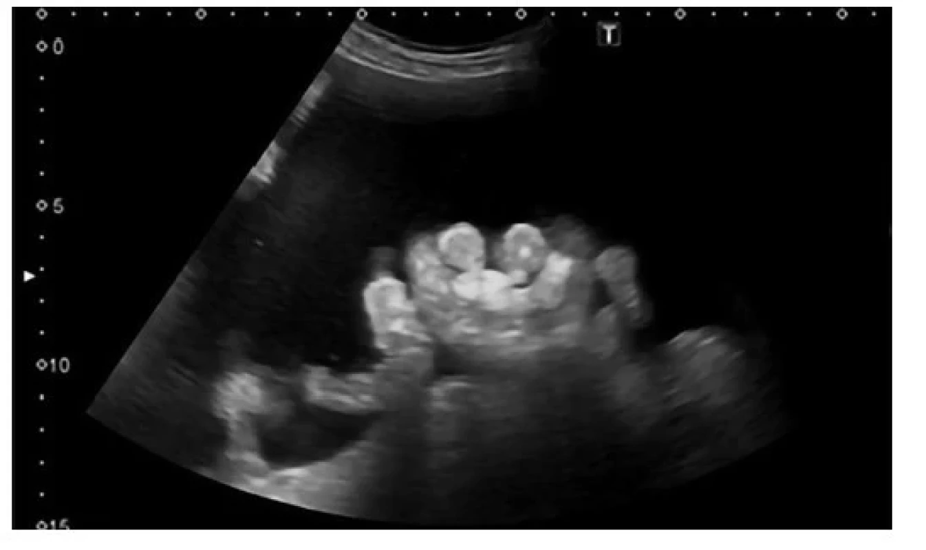 Objemný ascites