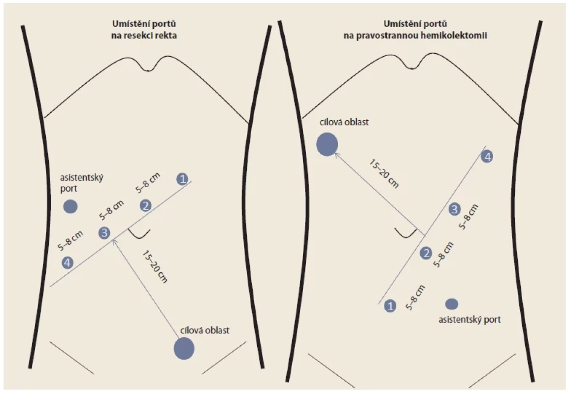 Rozmístění robotických portů při resekci rekta a při pravostranné hemikolektomii. <br> 
Fig. 1. Port placement for robotic rectal resection and right-sided hemicolectomy.