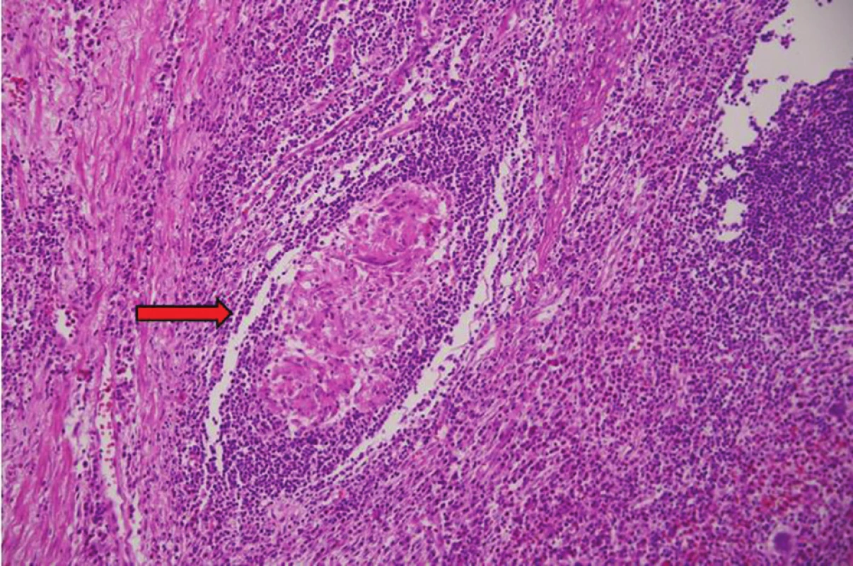 Histologie z resekátu<br>
Apendix v barvení hematoxylinem − eozinem ve 200x zvětšení
– epiteloidní granulom (označen šipkou) – histologicky
typický pro Crohnovu chorobu.<br>
(Bennet R., Oddělení patologie, Nemocnice Hořovice)<br>
Fig. 3: Resected specimen histology<br>
Appendix in hematoxylin − eosin staining, 200x magnifi cation
− epitheloid granuloma (marked by arrow) – histologically
typical for Crohn´s disease.<br>
(Bennett R., Department of Pathology, Hořovice Hospital)