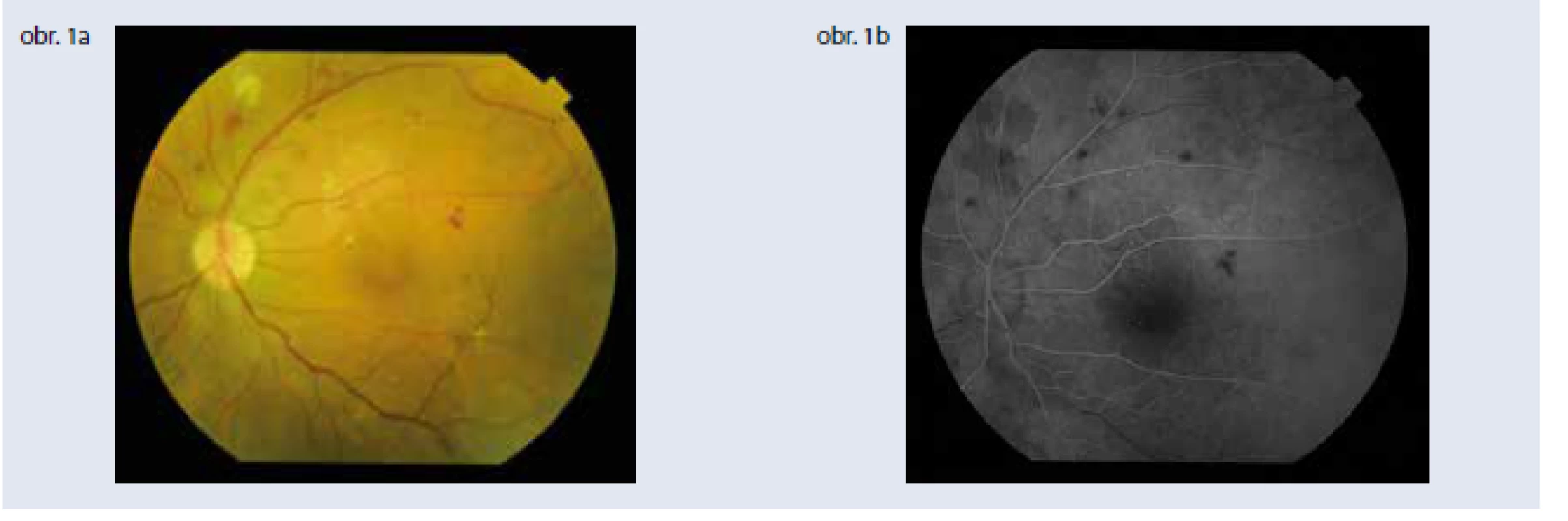 Klinické parametre a štandardná zobrazovacia vyšetrovacia metóda – fluoresceínová angiografia –
sú stále základom diagnostiky diabetickej retinopatie. Obr. 1a | Závažná neproliferatívna diabetická
retinopatia Obr. 1b | Fluoresceínová angiografia závažnej neproliferatívnej diabetickej retinopatie,
artério-venózna fáza. Archív autorky