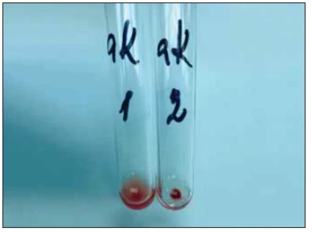 Stanovení antigenu K na erytrocytech 0 Kk Cw– po
adsorpci odlišných anti-K protilátek