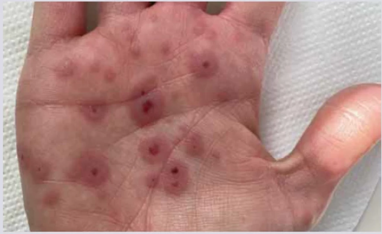 Erythema exsudativum multiforme. <br> 
Fig. 13. Erythema exsudativum multiforme.