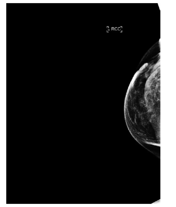 Mamograf, rezistence v jizvě, ložisková léze není
jednoznačně patrna.<br>
Fig. 7: Mammogram, resistance in the scar, the focal lesion
is not clearly identified.