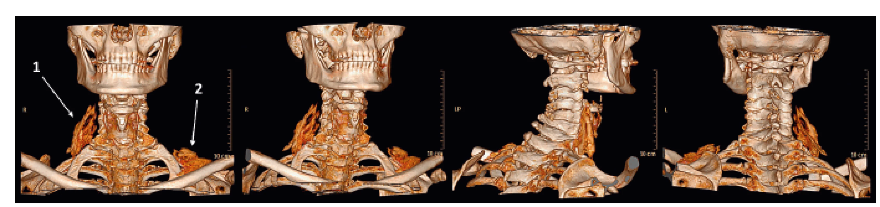 3D rekonstrukce šíření tekutiny po aplikaci 10 ml fyziologického roztoku do pravého fasciálního prostoru mezi m. scalenus
dorsalis a m. levator scapulae. Zároveň je patrné na levé straně náplň fascie m. omohyoideus rovněž 10 ml fyziologického roztoku.