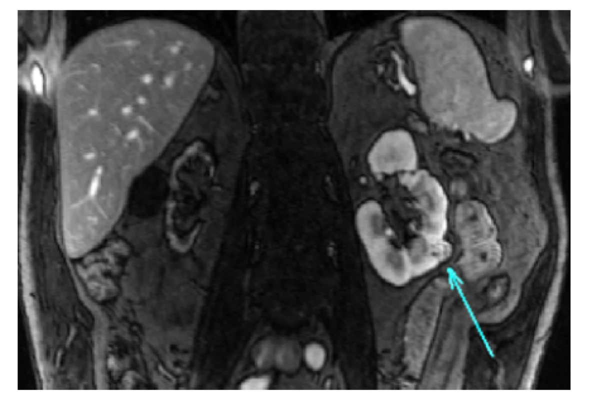 MR břicha, koronární řez. Tumor funkčně
solitární levé ledviny cT1a (14 mm) RENAL skóre 5a.
Řešeno laparoskopickou resekcí bez klampování hilu<br>
Fig. 1. MRI of the abdomen, coronal plane. Tumor of
the left functional-solitary kidney cT1a (14 mm) RENAL
score 5a. Laparoscopic partial nephrectomy with zero
ischemia time was performed