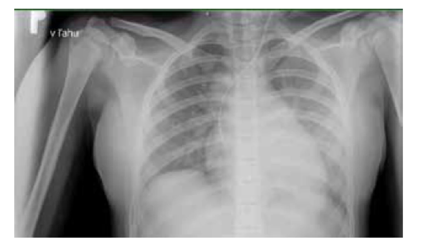 RTG vyšetrenie pľúc pacientky z klinického prípadu 2
– obraz bilaterálnej bronchopneumónie.<br>
Fig. 4. X-ray examination of the patient’s lungs from case report
2 – bilateral bronchopneumonia.