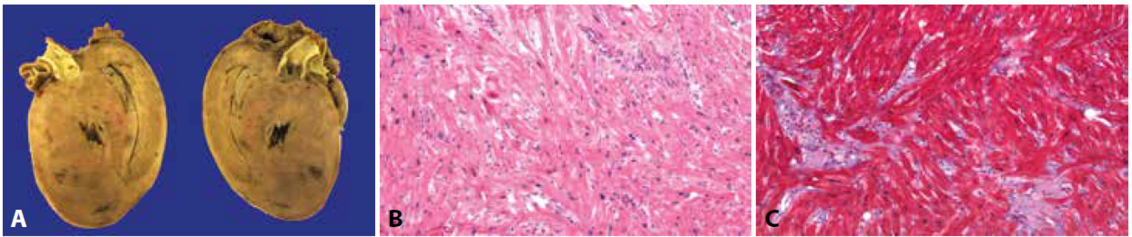 Explantované srdce s geneticky podmíněnou hypertrofickou kardiomyopatií.<br>
A: V makroskopickém nálezu dominuje výrazná hypertrofie všech srdečních oddílů s maximem v levém komoře a mezikomorovém septu.<br>
B, C: Charakteristický obraz disarray s nepravidelně se křížícími hypertrofickými kardiomyocyty a intersticiální fibrózou (hematoxylin & eosin, Massonův
trichrom, 200x).
