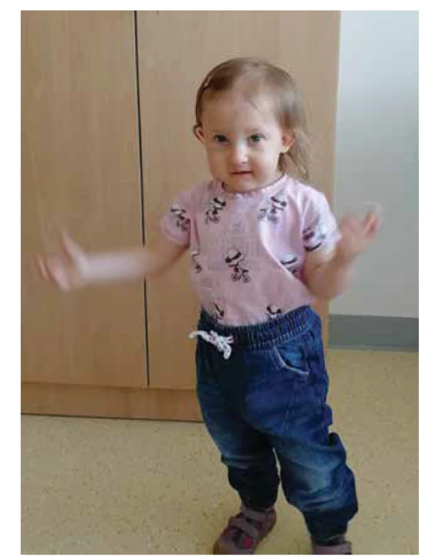 Pacientka s kompletním DiGeorgovým syndromem.<br>
Fig. 1. Patient with complete DiGeorge syndrome.
