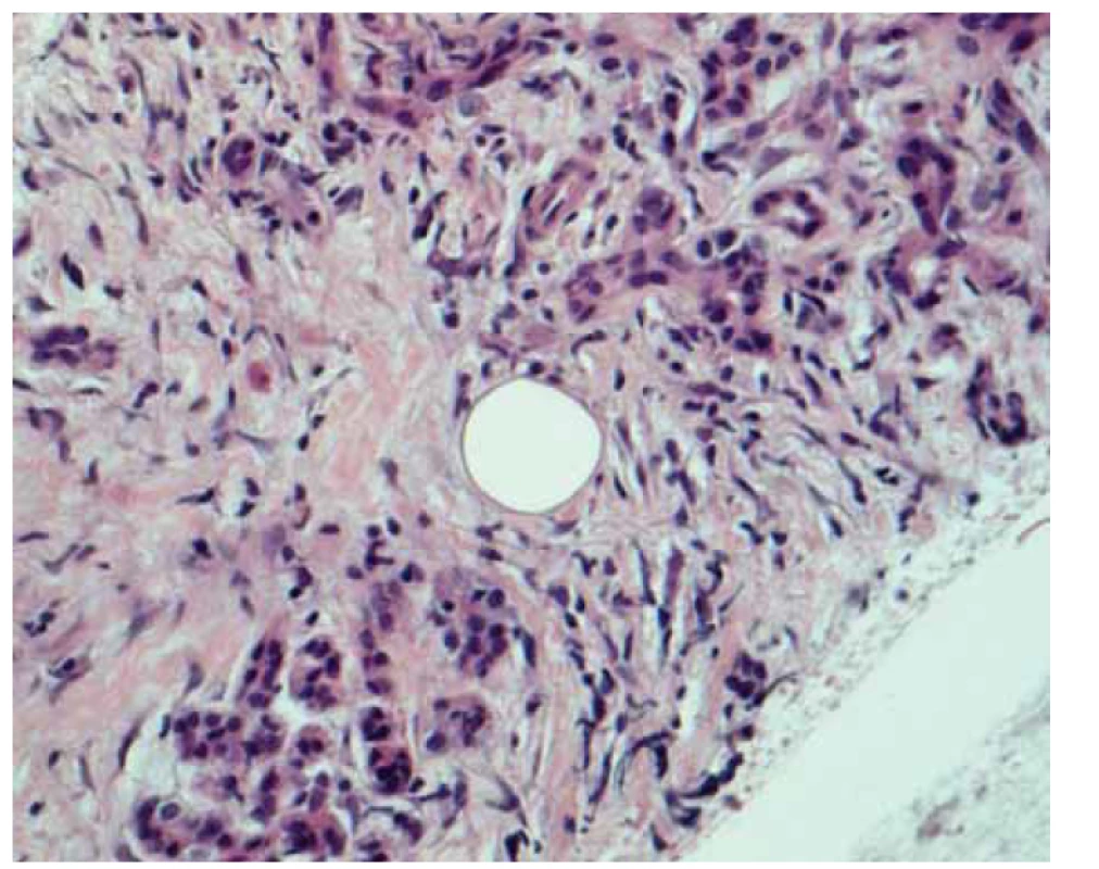 Histologický nález: glandulárny parenchým pankreasu s lymfoidnými
bunkami, ktoré sú zmesou CD3+ T-lymfocytov a CD 20+ B-lymfocytov.<br>
Fig. 4. Histological finding: glandular parenchyma of the pancreas with lymphoid
cells, which are a mixture of CD3+ T-lymphocytes and CD 20+ B-lymphocytes.
