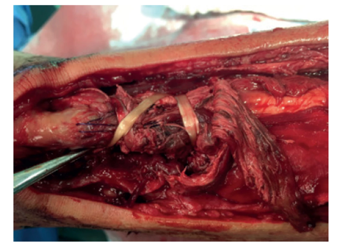 Augmentace sutury šlachou m. plantaris<br>
Fig. 3: Suture augmentation using the plantaris muscle
tendon