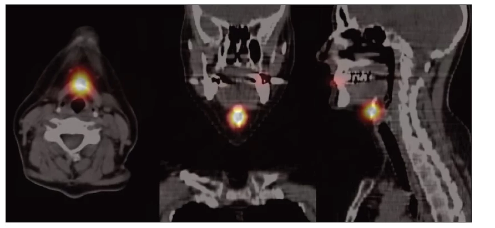 Hybridní
SPECT/CT po
opakované terapeutické
aplikaci
131I u 59leté
ženy, radiojód
akumulující
reziduum vysoko
na krku ve
střední čáře.