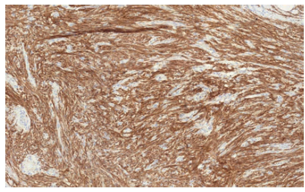  GIST pozitivně silně reaguje s protilátkou CD117<br>
Fig. 2. GIST reacts positively with CD117 antibodies