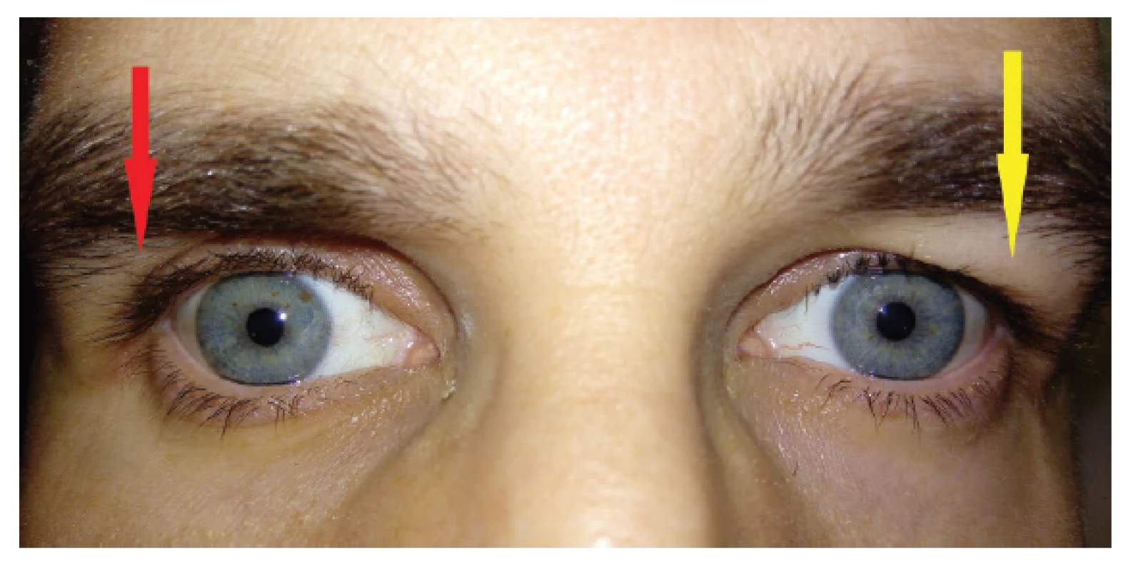 Blefarochalasis of the left eye, deep orbitopalpebral sulcus
on right eye
