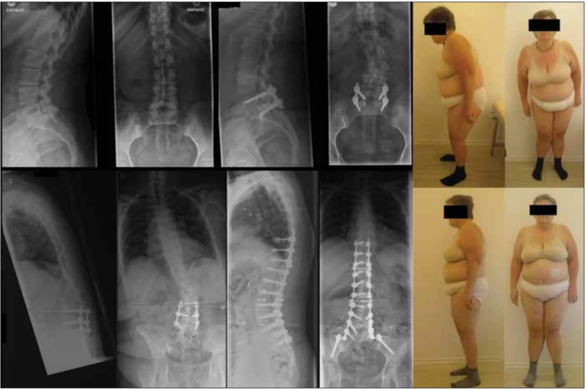 57-ročná pacientka po PLIF L5/S1 pre isthmickú spondylolistézu (na inom pracovisku), v tej dobe iba minimálna skoliotická
krivka. Po 10 rokoch bolo pre progredujúcu krivku na tom istom pracovisku realizované predĺženie fi xácie po L3 – bol zvolený neadekvátny rozsah výkonu, v priebehu 2 rokov masívna progresia ťažko dekompenzovanej kyfoskoliózy, bola realizovaná rozsiahla stabilizácia s kompletnou korekciou deformity, subj. výrazné zmiernenie bolestivého syndrómu.<br>
Fig. 2. 57-year old female patient after PLIF L5/S1 for isthmic spondylolisthesis (at a diff erent department) at that time with minimal
scoliotic curve. After 10 years, for the progression of the curve, extension of fi xation up to L3 was performed at the same department
– inadequate extension was chosen, and in 2 years,there was massive progression of severe decompensated kyphoscoliosis. Extensive
stabilization with complete correction of the deformity was made, with subjective alleviation of the pain syndrome.
