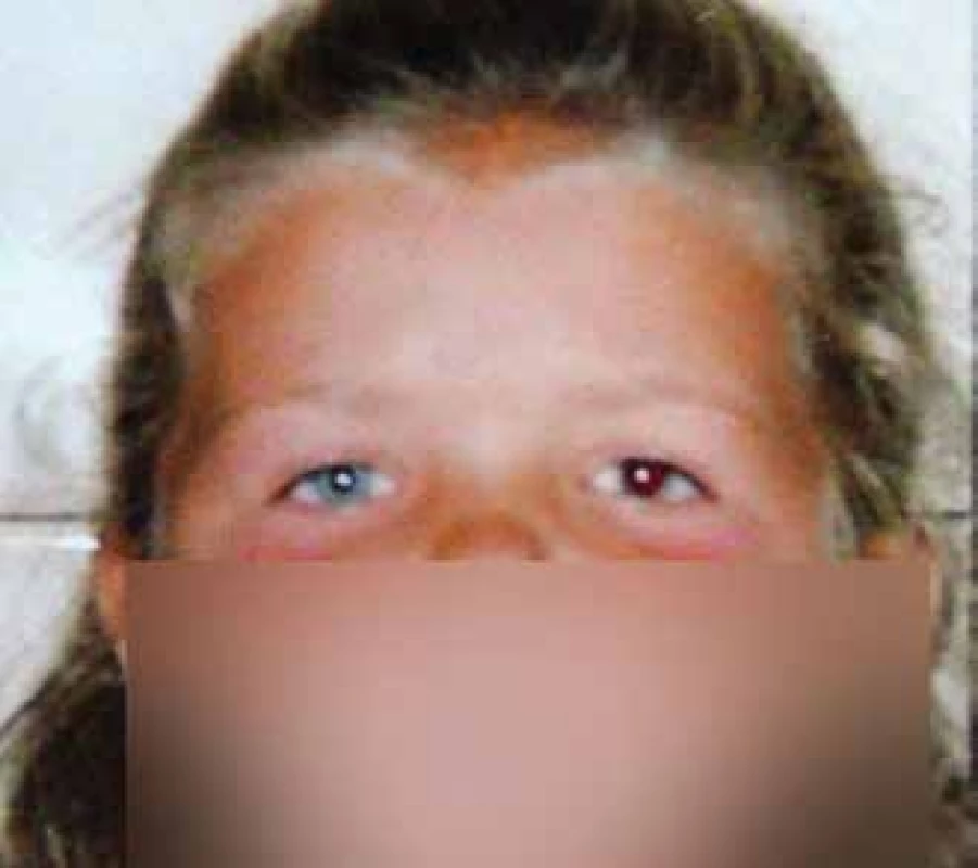 Anisocoria upon dilation of pupil in left eye in a 6-year-
old patient