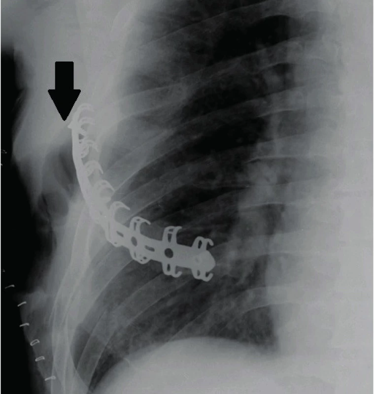 Částečné selhání osteosyntézy (uvolnění zamykacího šroubu
– viz šipka), které nevedlo k mechanickému selhání osteosyntézy, pacient dosáhl plného kostního prohojení, šroub dále nemigroval