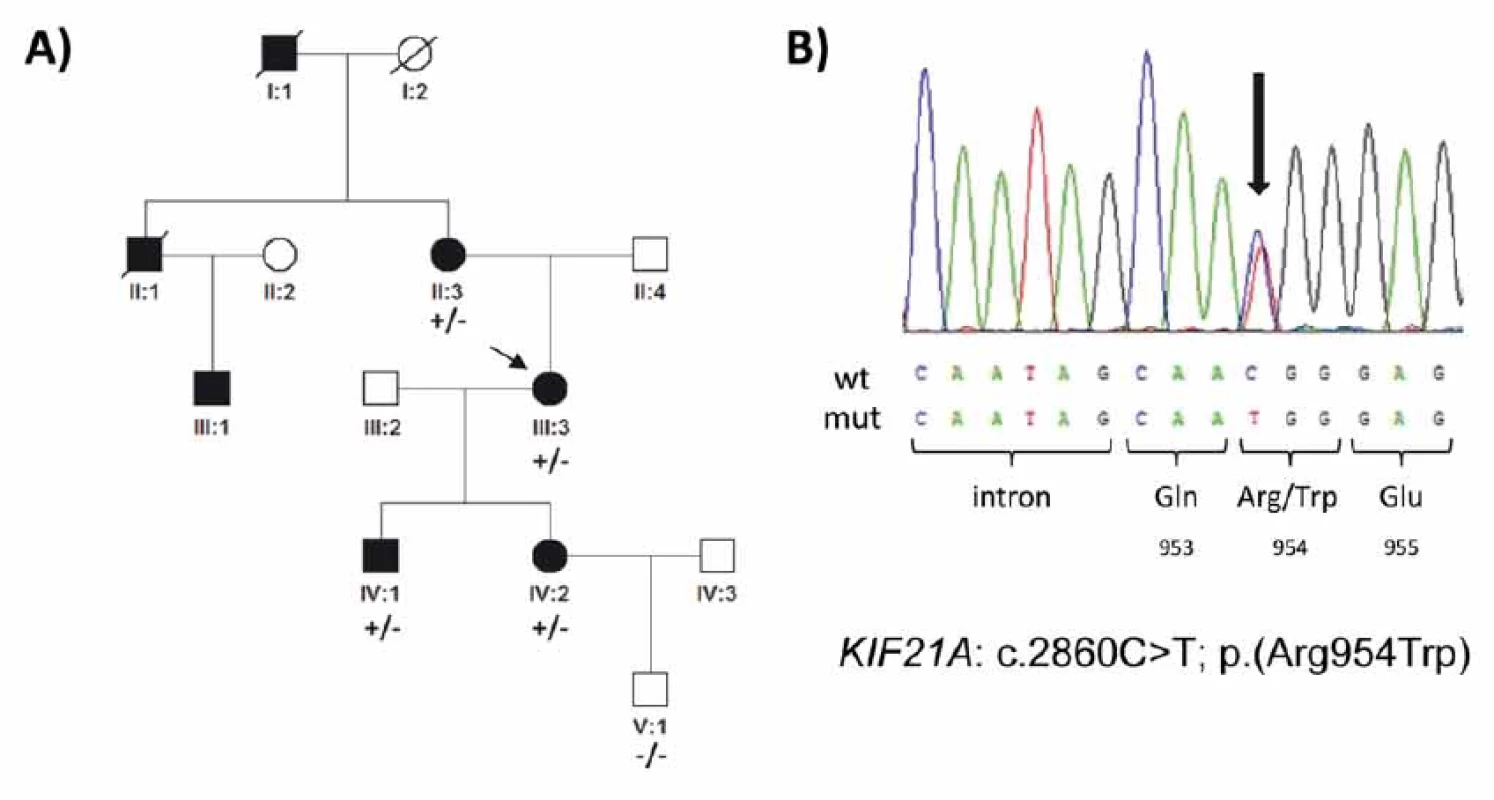 Genetické nálezy v rodině s kongenitální fibrózou zevních okohybných svalů. (A) Rodokmen rodiny a segregace mutace
c.2860C>T v heterozygotním stavu. Probandka je označena šipkou. (B) Sekvenční chromatogram detekované mutace (označená šipkou),
mutace mění na pozici 954 kodon pro aminokyselinu arginin na tryptofan. Postižené ženy jsou zobrazeny černým kolečkem,
muži čtverečkem; +/– označuje jedince pozitivně testovaného na přítomnost mutace c.2860C>T; –/– jedince bez nálezu mutace.<br>
Fig. 2. Genetic fi ndings in a family with congenital fibrosis of the extraocular muscles. (A) Pedigree of the family and segregation of the
heterozygous mutation c.2860C>T. The proband is indicated by an arrow. (B) Sequence chromatogram; the mutation (arrow) causes
an arginine to tryptophan amino acid substitution at codon 954. Aff ected females are represented by black circles and males by black
squares; mutation status in tested subjects is shown +/− for those who are heterozygous for the identifi ed mutation and −/− for those
who do not carry the pathogenic variant.
