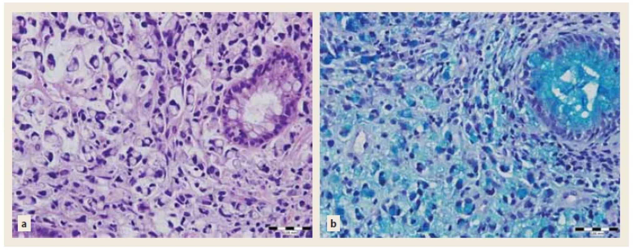 a) Histopathologic examination of colonic biopsy. Haematoxylin and eosin staining of the tissue with mucin producing poorly
diff erentiated adenocarcinoma in muscularis propria with signet ring cell features. Enlargement 40×. <br> 
Fig. 5b) Histopathologic examination of colonic biopsy. Alcian blue staining of the mucin producing poorly diff erentiated adenocarcinoma
in muscularis propria with signet ring cell features. Enlargement 40×. <br> 
Obr. 5a) Histopatologické zhodnocení střevní biopsie. Barvení hematoxylinem a eosinem. Záchyt nízce diferencovaného mucin produkujícího
adenokarcinomu v lamina muscularis propria s buňkami tvaru „pečetního prstene“. Zvětšení 40×. <br> 
Obr. 5b) Histopatologické zhodnocení střevní biopsie. Barvení alciánová modř. Záchyt nízce diferencovaného mucin produkujícího adenokarcinomu
v lamina muscularis propria s buňkami tvaru „pečetního prstene“. Zvětšení 40×.